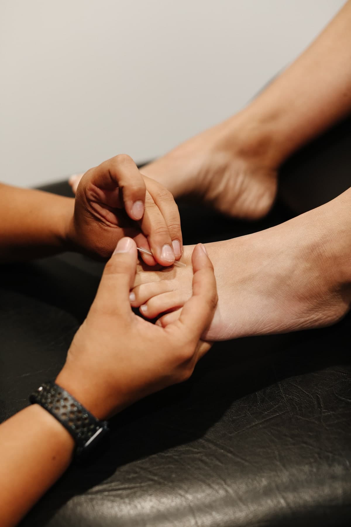 Close-up of a physiotherapist's hands placing an acupuncture needle on a patient's foot, with the patient's other foot visible behind, on a black treatment table in Swift Current